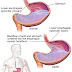 Gastroesophageal reflux| GERD| Heartburn and its management