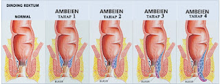 cara menghilangkan ambeien secara alami
