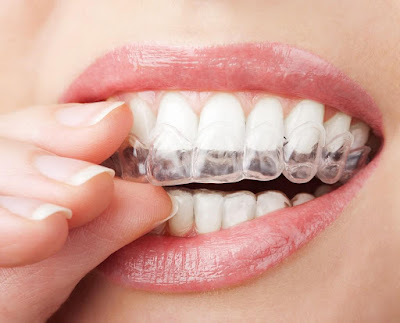 Kỹ thuật niềng răng không mắc cài thẩm mỹ?