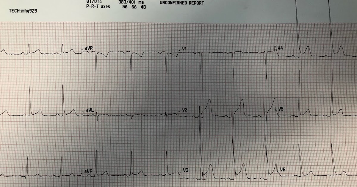 Dr. Smith's ECG Blog Is this terminal QRS distortion? Is there LVH?