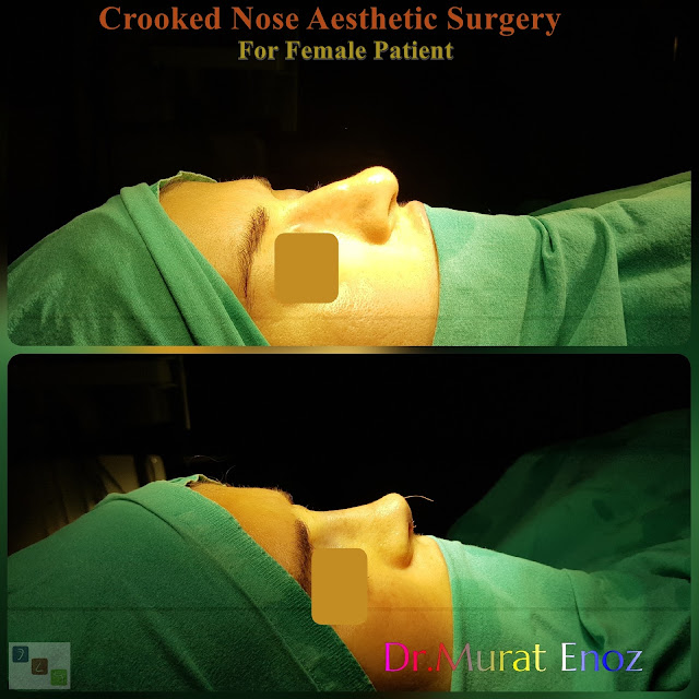 Crooked Nose Aesthetic Surgery For Women