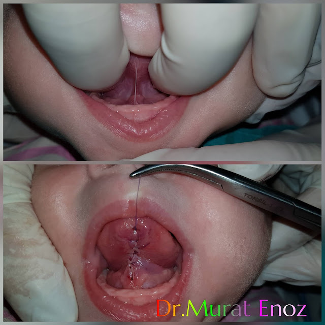 Ankyloglossia,Diagnosis of Tongue Tie,Treatment of Tongue Tie,Tongue tie surgery,Frenulectomy,Post-Operative Instructions for Tongue Tie Surgery,Symptoms of Tongue Tie,tongue tie,Frenectomy,