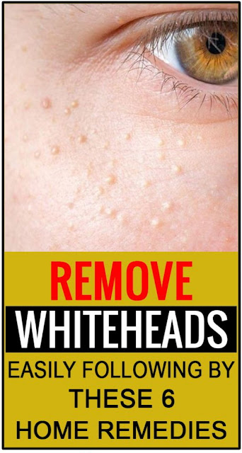 How To Remove Small White Skin Cysts Easily In Home