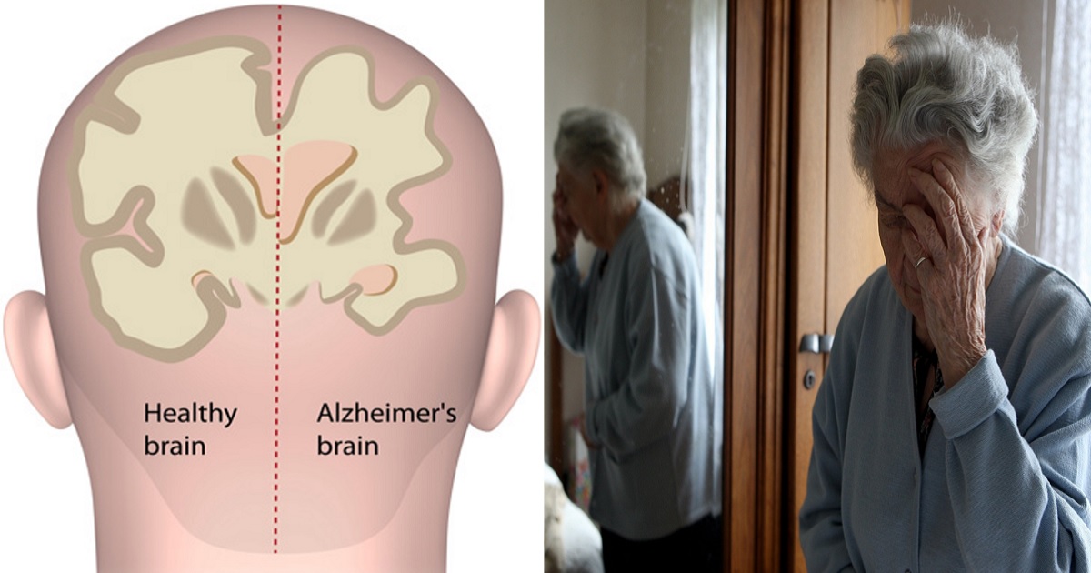 Терминальная деменция. Болезнь Альцгеймера деменция. Болезнь Альцгеймера картинки. Мозг старика.