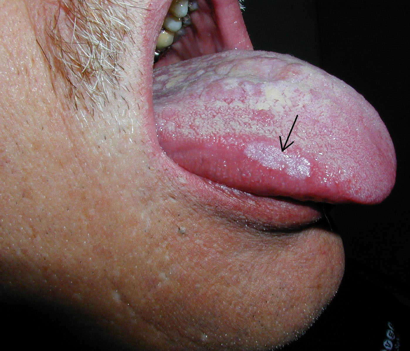 Keratosis Mouth 10