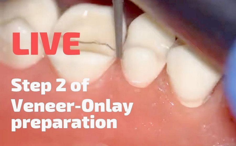 TOOTH PREPARATION VeneerOnlay preparation