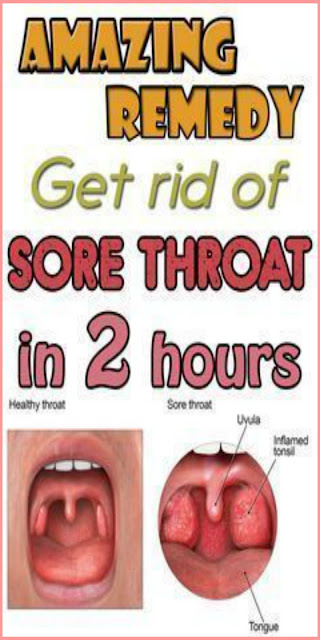 Sore Throat Remedies