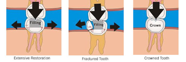 why crown after root canal treatment