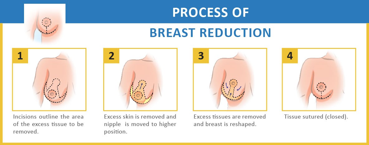 cost india reduction Breast in