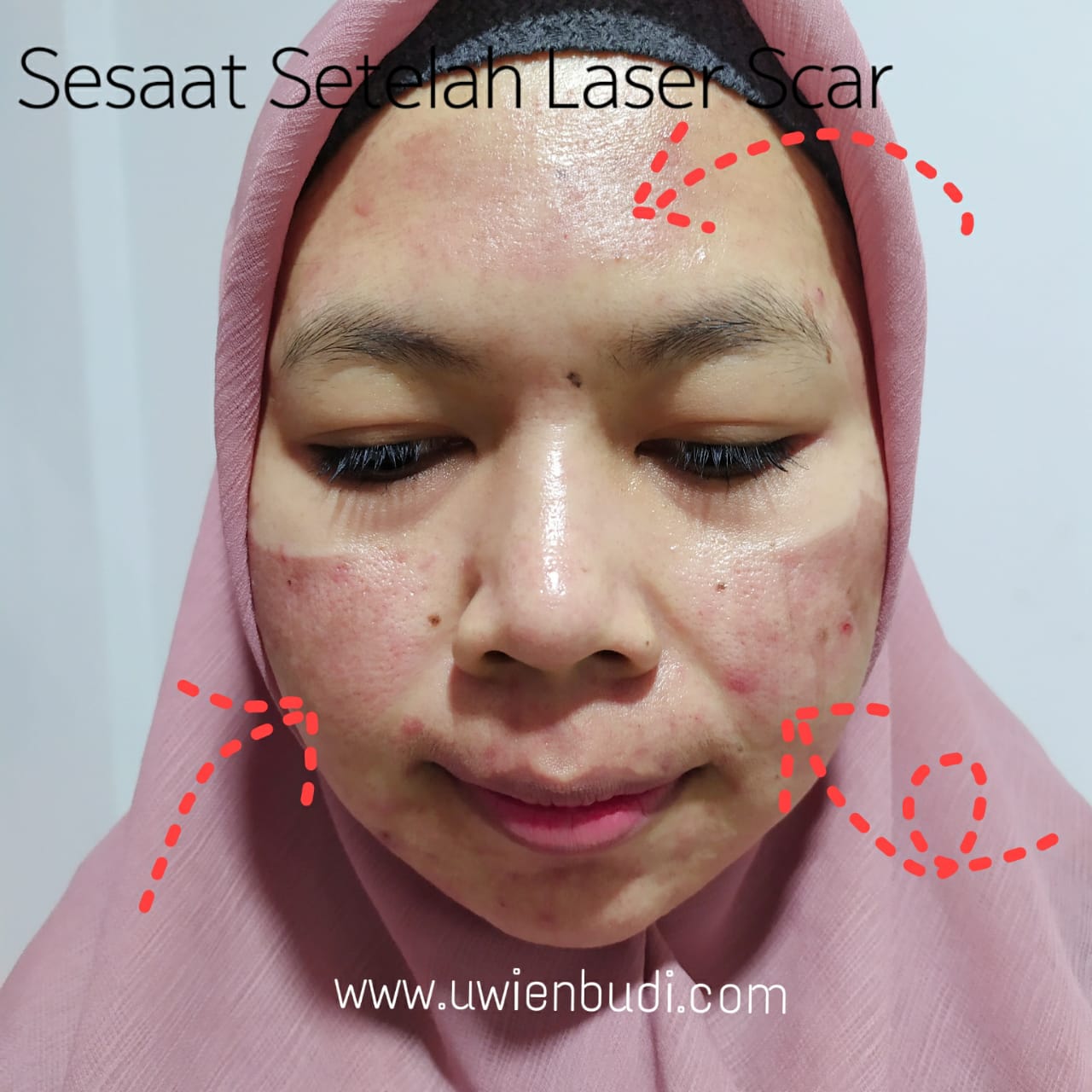 nampak depan. pipi kirikanan dan dahi adalah area yang dilaser