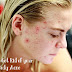 How to Get Rid of Body Acne