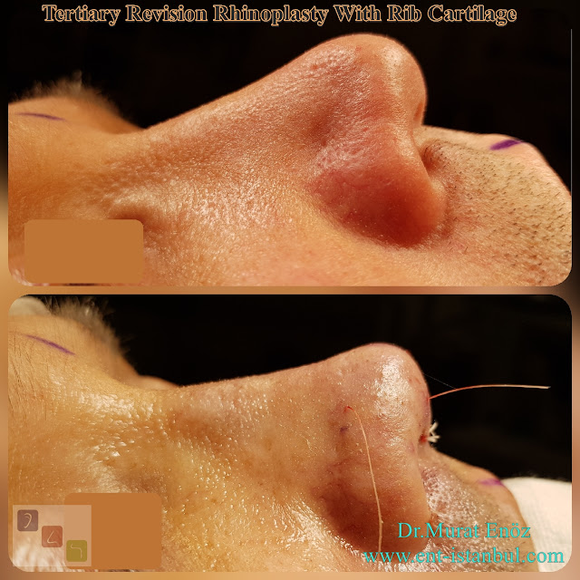 Tertiary Revision Rhinoplasty With Rib Cartilage