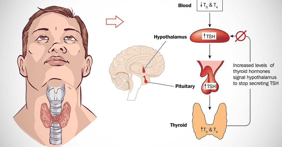 Alimentacion tiroiditis de hashimoto