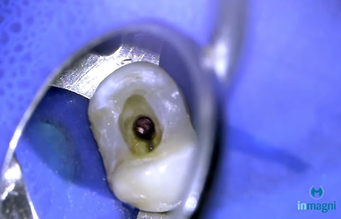 ENDODONTIA: Tratamento de canal como remover guta percha no terço apical dos canais - Angelo Freire