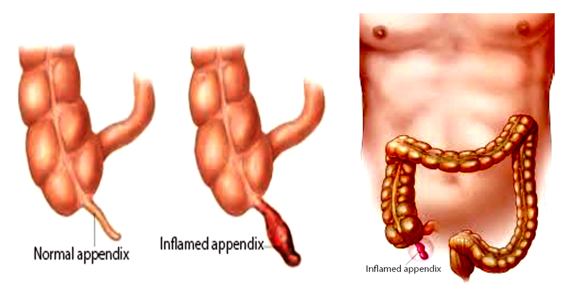 Appendicitis Signs and symptoms, Causes, diagnosis, and
