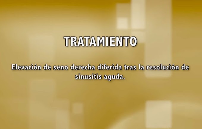 IMPLANTOLOGÍA: Elevación de seno maxilar diferido tras la resolución de Sinusitis Aguda - Dr. Ismael Soriano