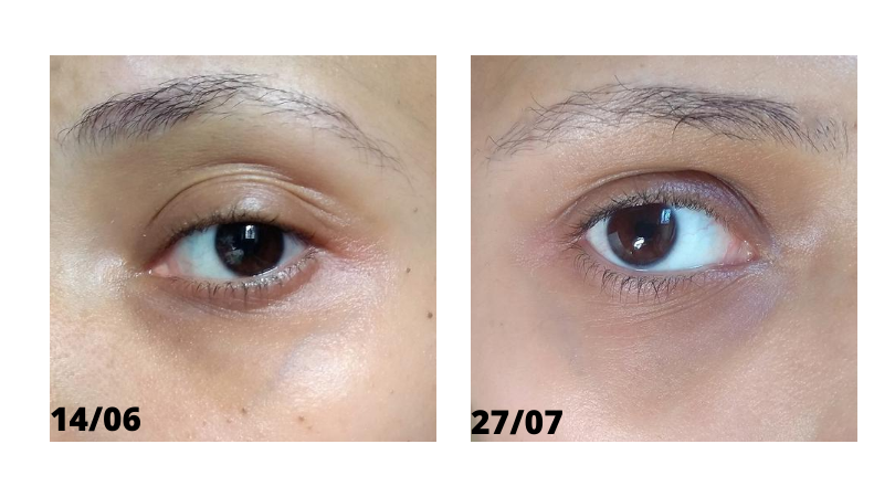 Sérum Vegano Para Área dos Olhos Hidrabene - Resenha Sérum Vegano Para Área dos Olhos Hidrabene Antes e depois - resultado na pele