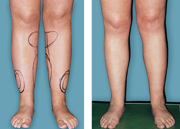 Laser Liposcustion for calves andles and  legs