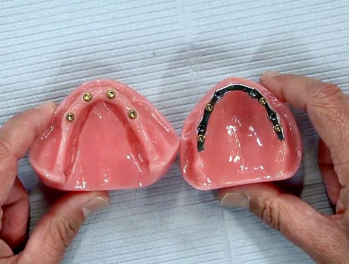 ORAL REHABILITATION: Placing a Removable Lower Denture Attached to Implants