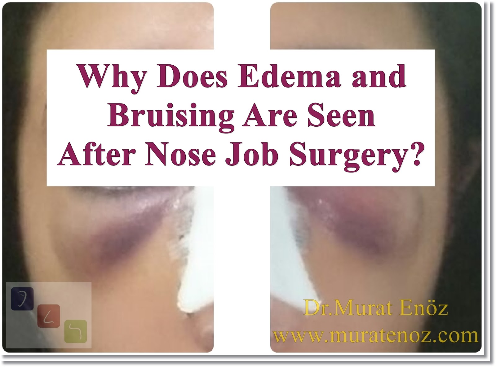bruising from deep tissue massage bruising from deep tissue massage