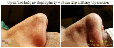 Open technique septoplasty in İstanbul - Nose tip lifting in İstanbul - Open tecnique septoplasty operation - Open technique nose tip plasty in İstanbul - Open technique nose tip lifting in Turkey - Nose tip drooping - Open technique nasal septum correction surgery - Septum deviation surgery - Treatment of nose tip droops - Treatment of nasal tip droop when smiling - Nose tip droops when smiling - Droopy nose tip surgery