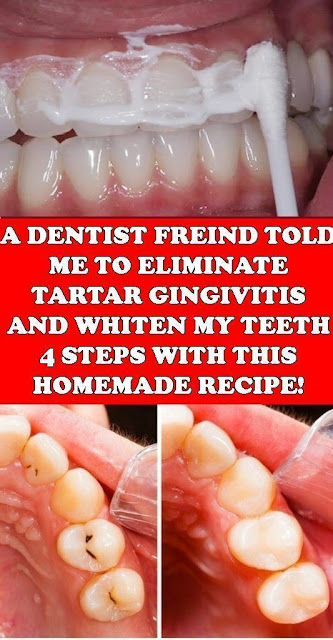 How To Eliminate Tartar, Gingivitis, And Whiten My Teeth In 4 Steps With This Magical Trick