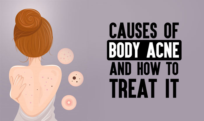 Causes of Body Acne and How to Treat it
