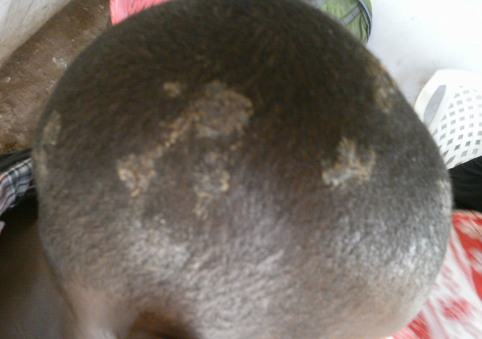Infections That Cause Hair Loss: Ringworm, Folliculitis ...