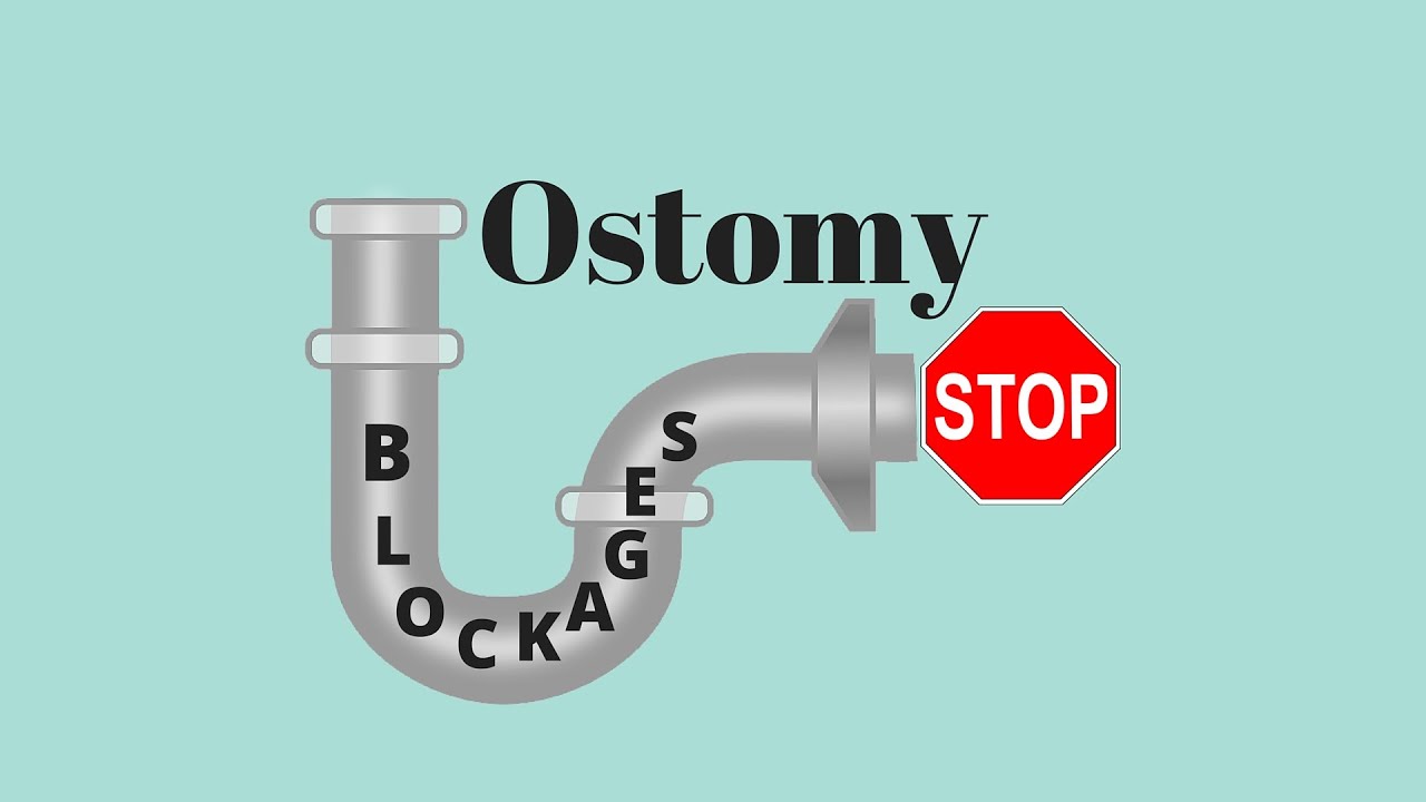 Digestive Hacks Tips To Unblock a Stoma