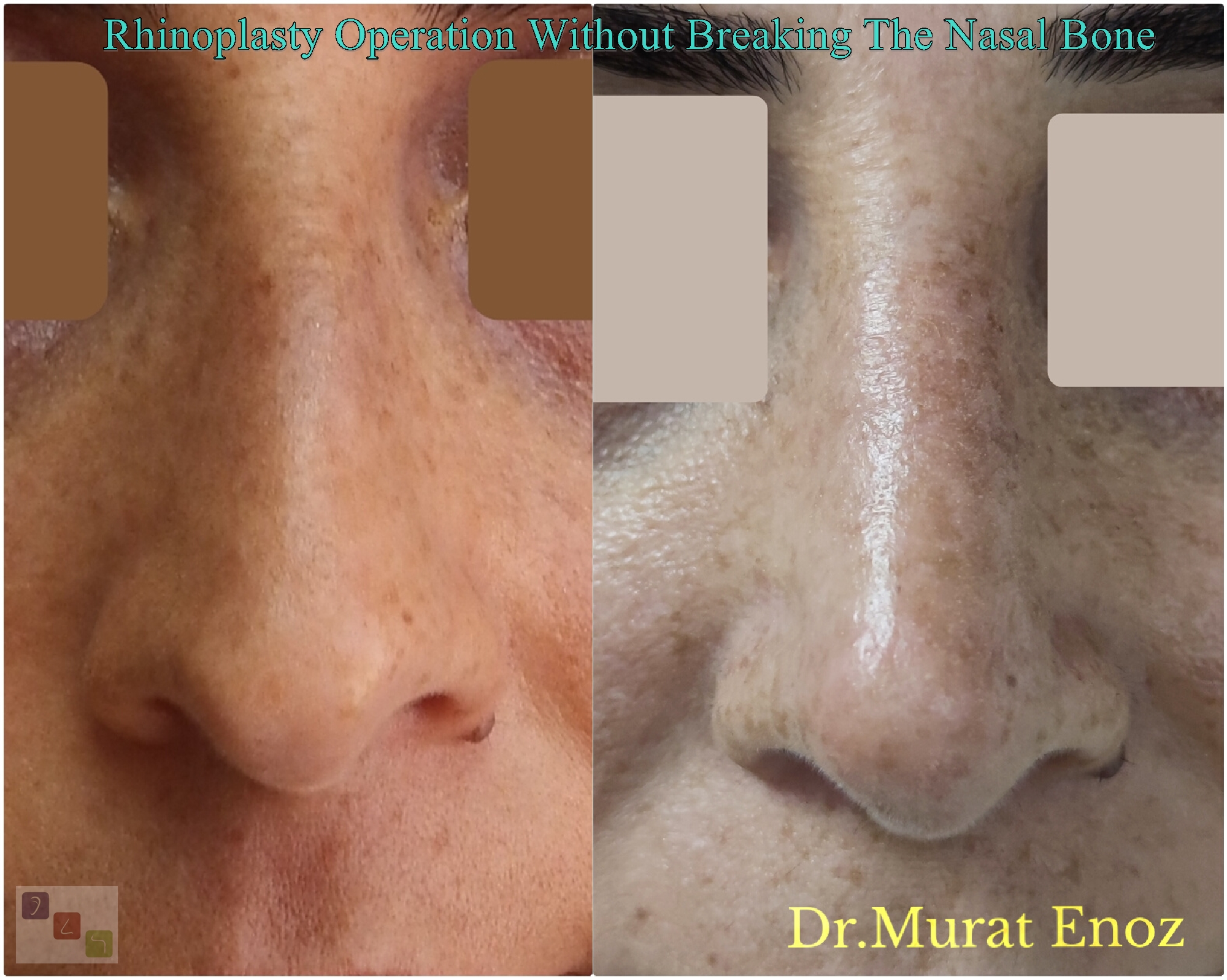 Rhinoplasty Operation Without Breaking The Nasal Bone