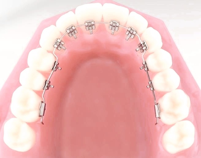 Tipos de Brackets Ventajas y Desventajas