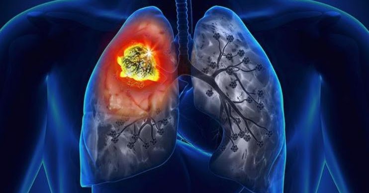 Carcinoid Tumor Lung Prognosis, Symptoms, And Treatment - CancerOz
