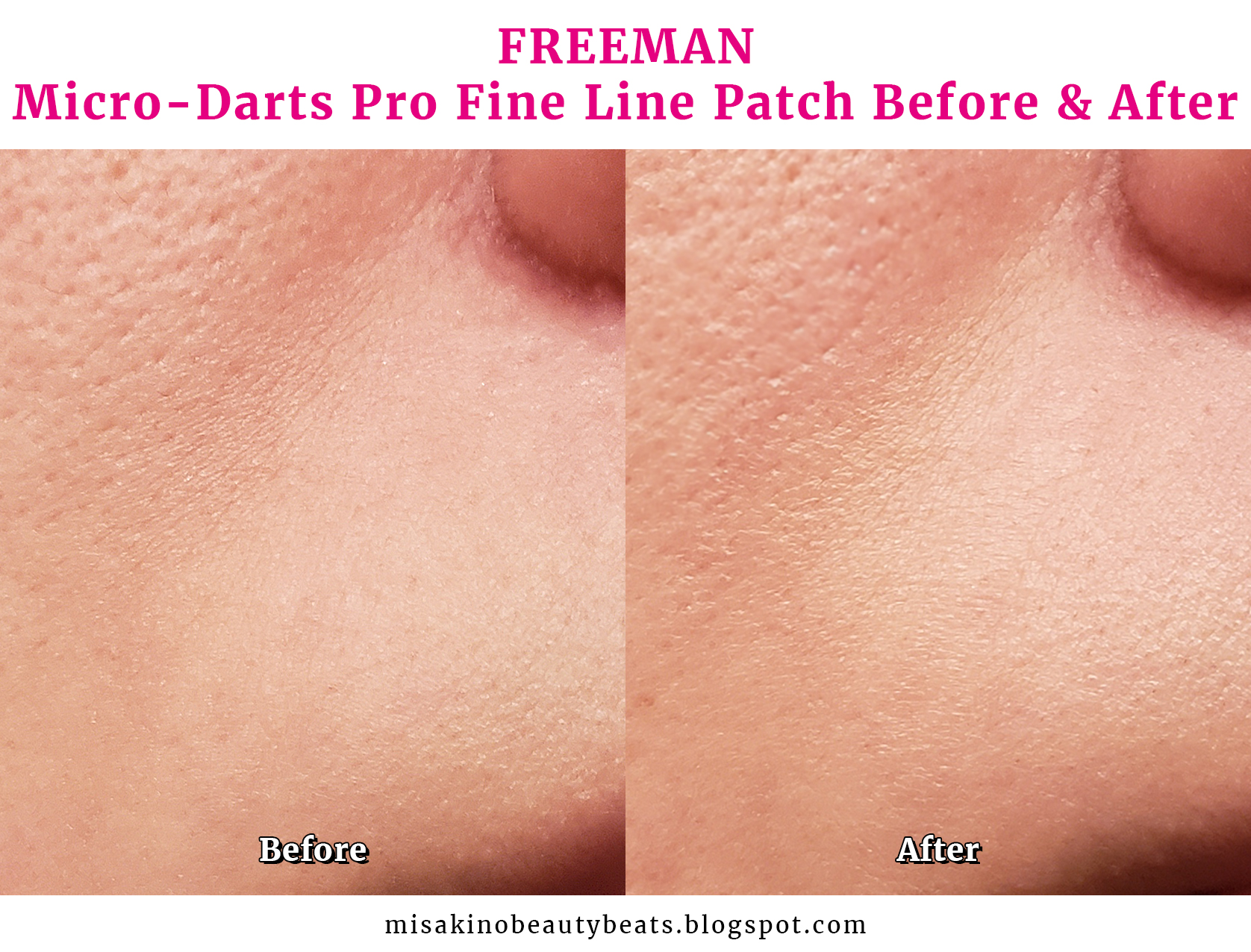 Review Freeman MicroDarts Pro Fine Line Patches MISAKINO