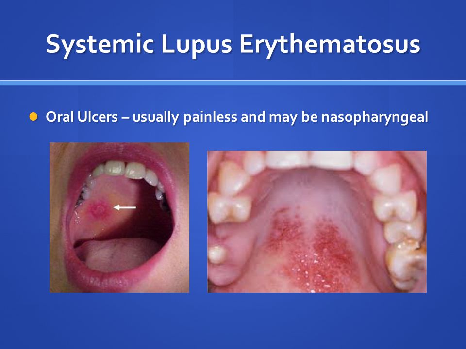 Fotos de lupus eritematoso sistemico