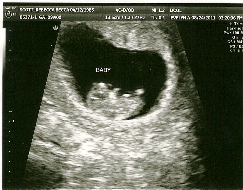 The Scotts Baby Makes Three First Ultrasound...9 weeks