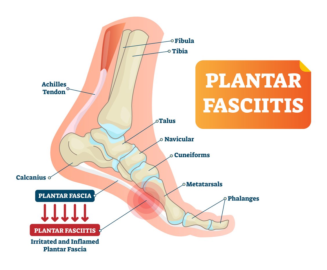 Plantar Fasciitis Causes, Symptoms, Treatments, and More
