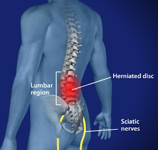 Slipped Disc Reedh ki haddi mein dard hone ki wajah aur iska ilaj (Slipped disc) cause & treatment in Hindi/Urdu.