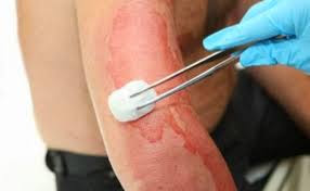 pengobatan tradisional luka tersiram air panas