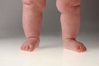 http://orthopedicsindia.com/deformity-correction-dwarfism-constitutional-short-stature.html