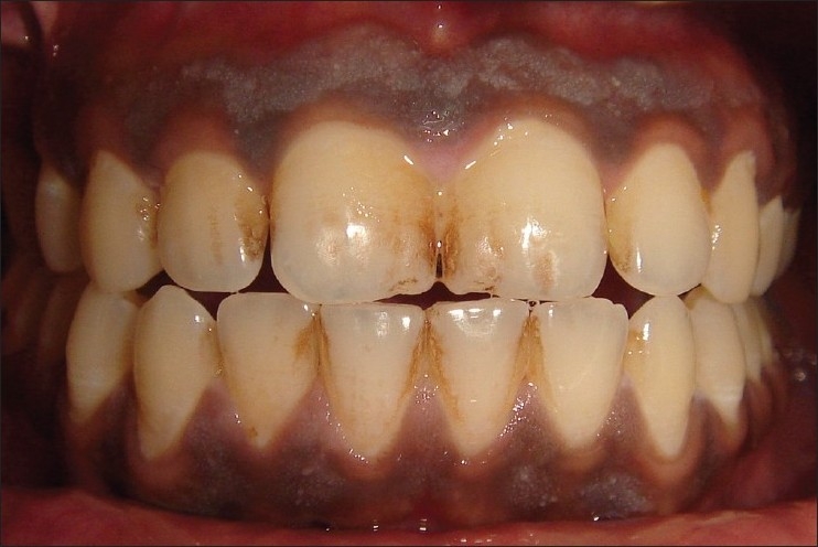zirkonyum dis nedir zirkon ve porselen dis kaplama fiyati istanbul turkiye