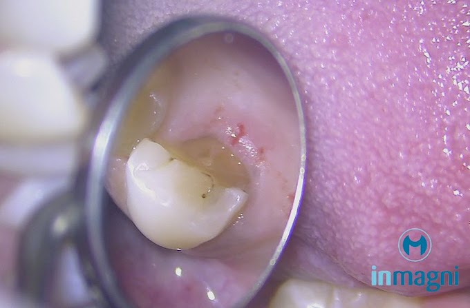 ENDODONTIA de dente fragilizado: Pré molar com fratura cúspide lingual - Angelo Freire