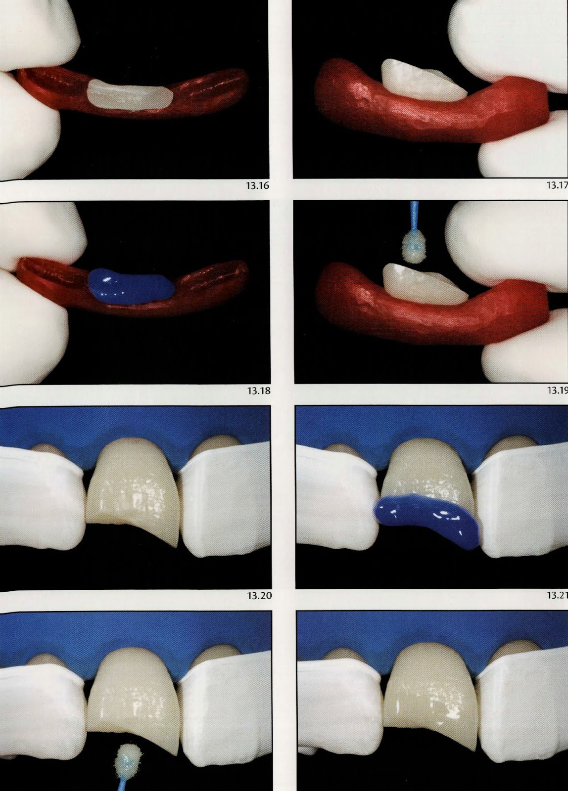 Tooth fragment reattachment Dental Esthetics