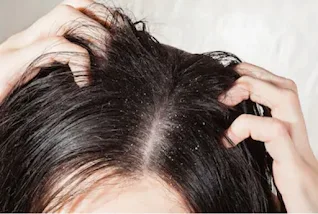 cara mengobati rambut rontok, harga sampo natur, mengapa rambut bisa rontok, sampo yang bagus untuk rambut rontok, harga sampo rambut rontok, makanan untuk mencegah rambut rontok, faktor yang menyebabkan rambut rontok,