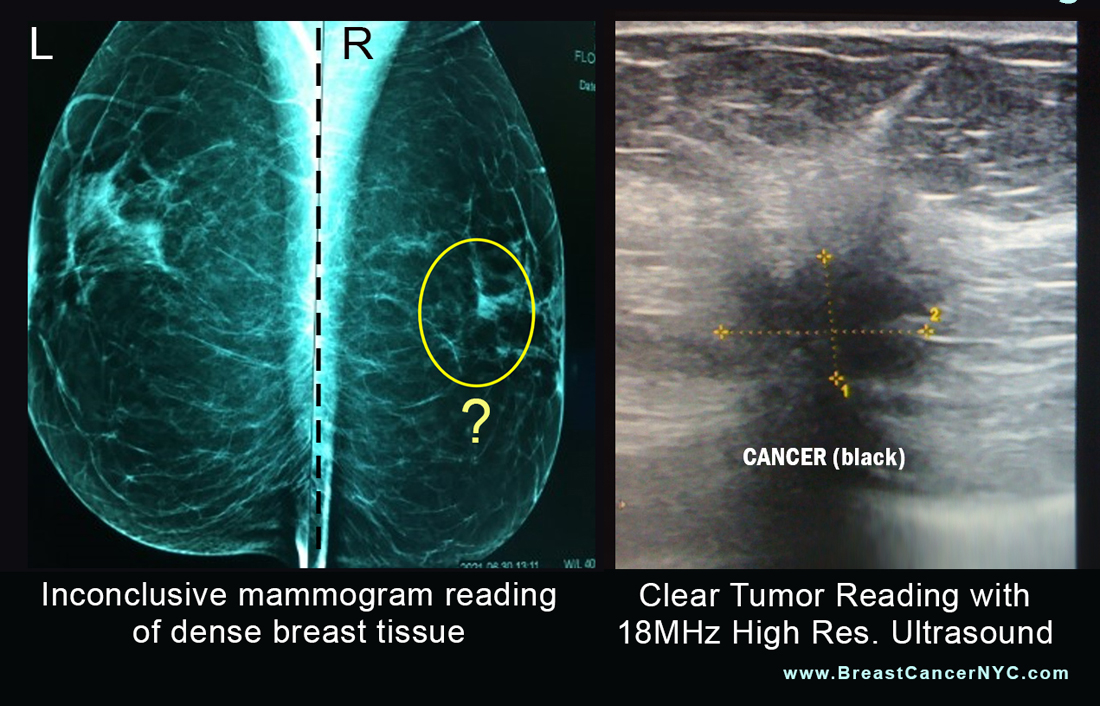 Breast Cancer Community News Ultrasound Significantly Reduces False