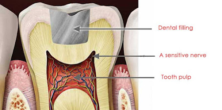 Tooth pain after filling tooth pain after filling,tooth pain,pain after filling,tooth sensitivity after filling,filling,tooth pain after deep filling,throbbing tooth pain after filling,pain after a filling,severe pain after filling,tooth pain weeks after filling,tooth pain after filling by dentist,how to relieve tooth pain after filling,is pain after tooth filling normal,what causes pain after tooth filling,tooth,nerve pain after filling,pain after cavity filling,tooth filling,teeth pain