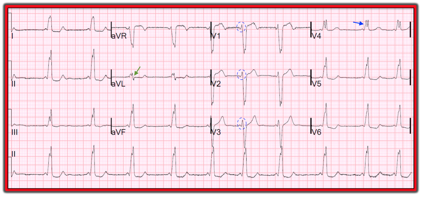 Dr. Smith's ECG Blog: What do you think about this Left Bundle Branch Block?