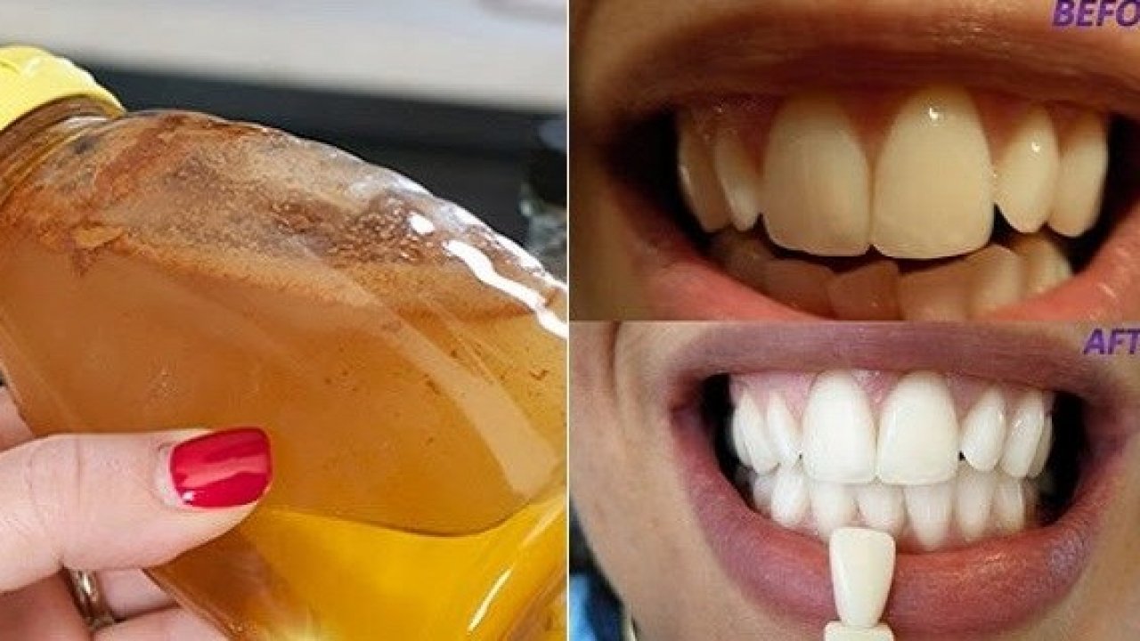 GARGLE WITH JUST ONE INGREDIENT AND SEE WHAT WILL HAPPEN TO YOUR TEETH!