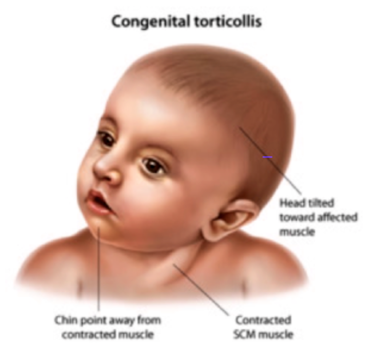 Head and Neck Anatomy Sternocleidomastoid Muscle