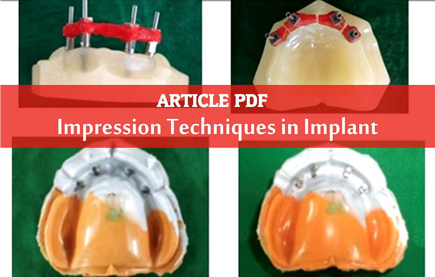 PDF Impression Techniques in Implant