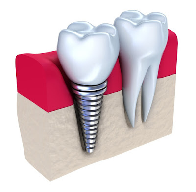  dental implants in Mulund